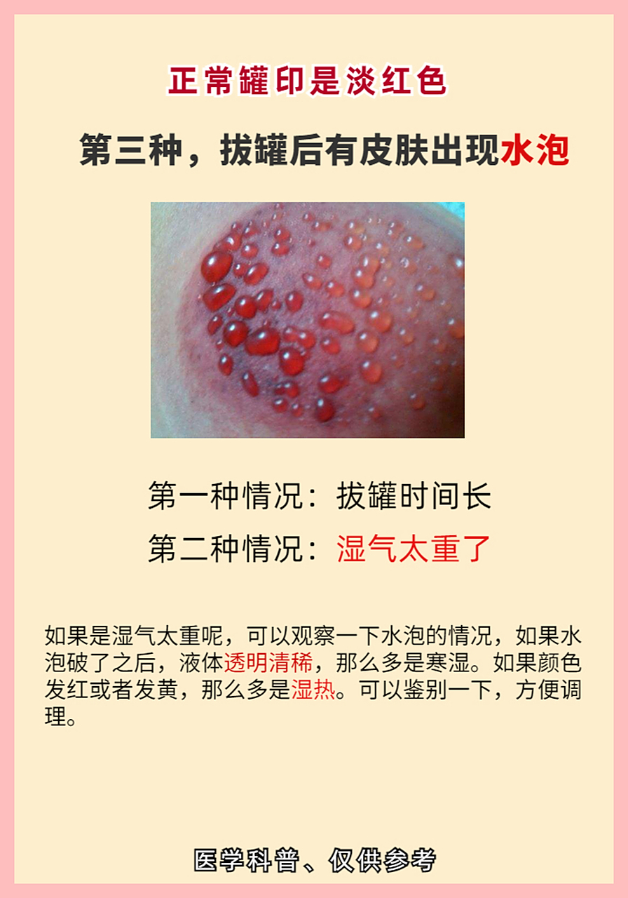 拔罐真的能治病?拔出来黑,紫,青,红各色的罐印都说明什么?