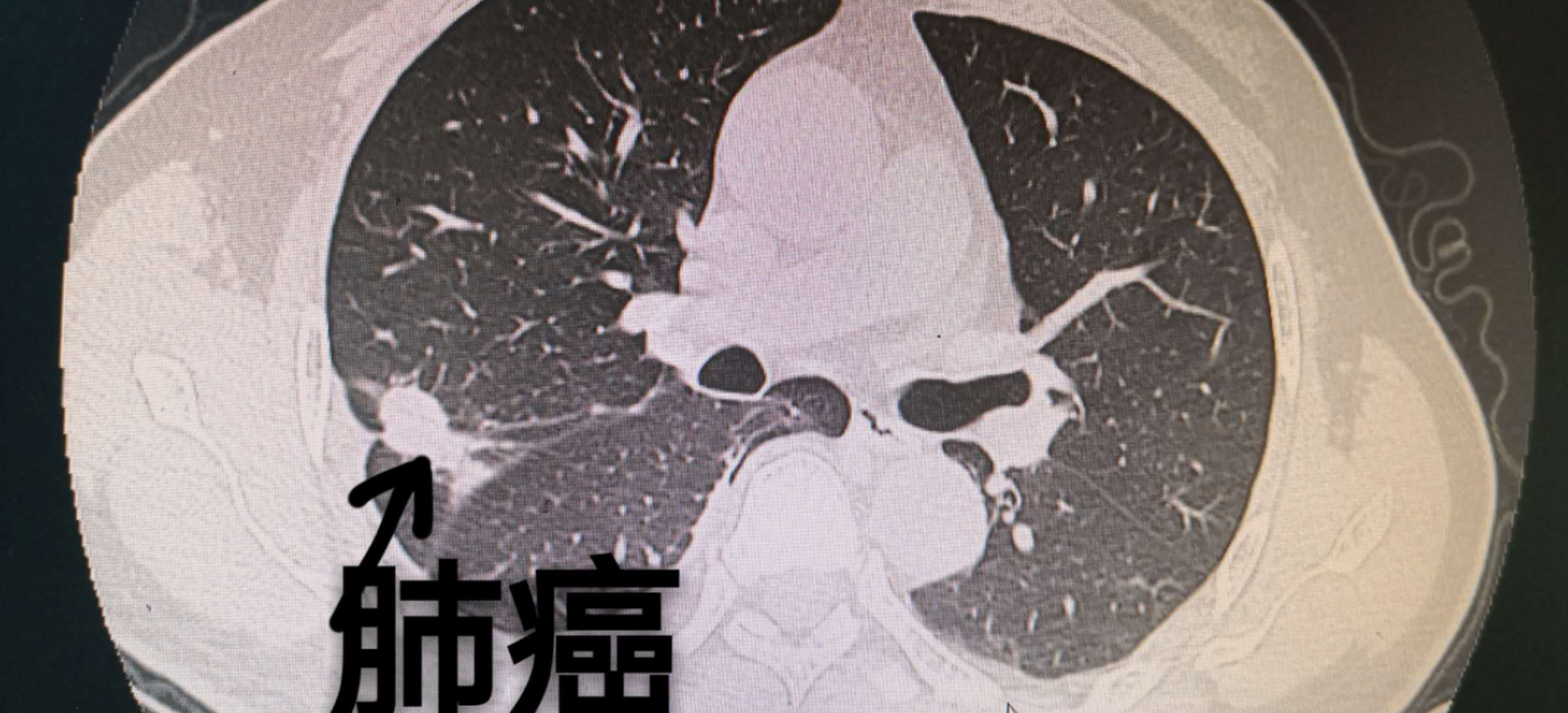 肺结节不等于肺癌,那什么样的结节可能是肺癌?