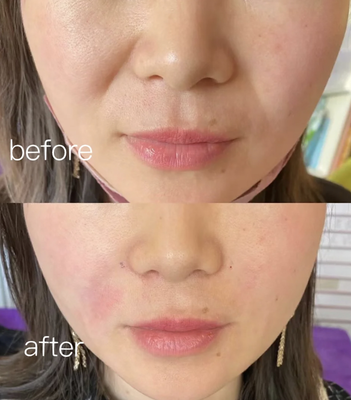 为什么鼻唇沟越来越凹,法令纹越来越深 鼻唇沟是面颊有动力软组织与无