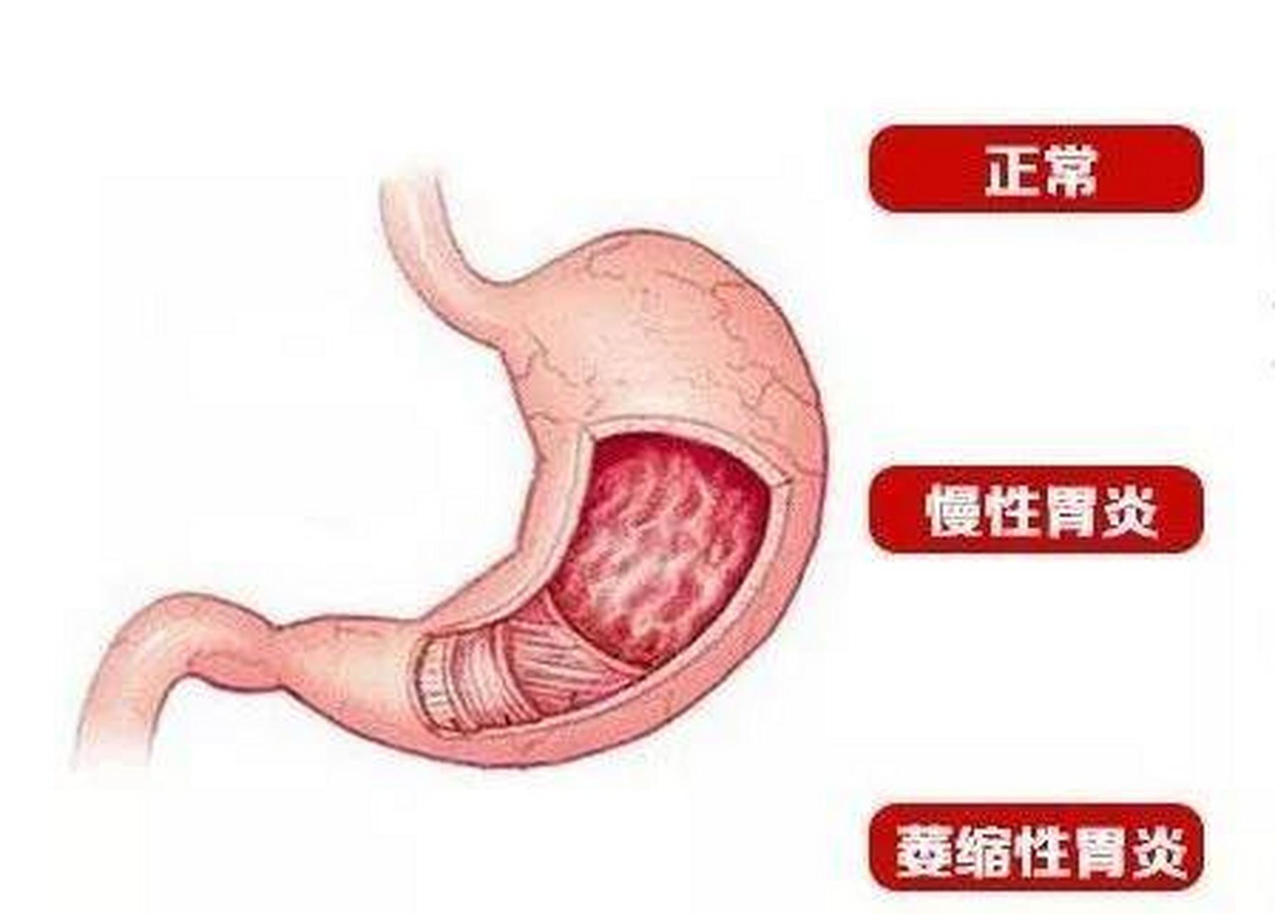 萎缩性胃炎严重吗图片