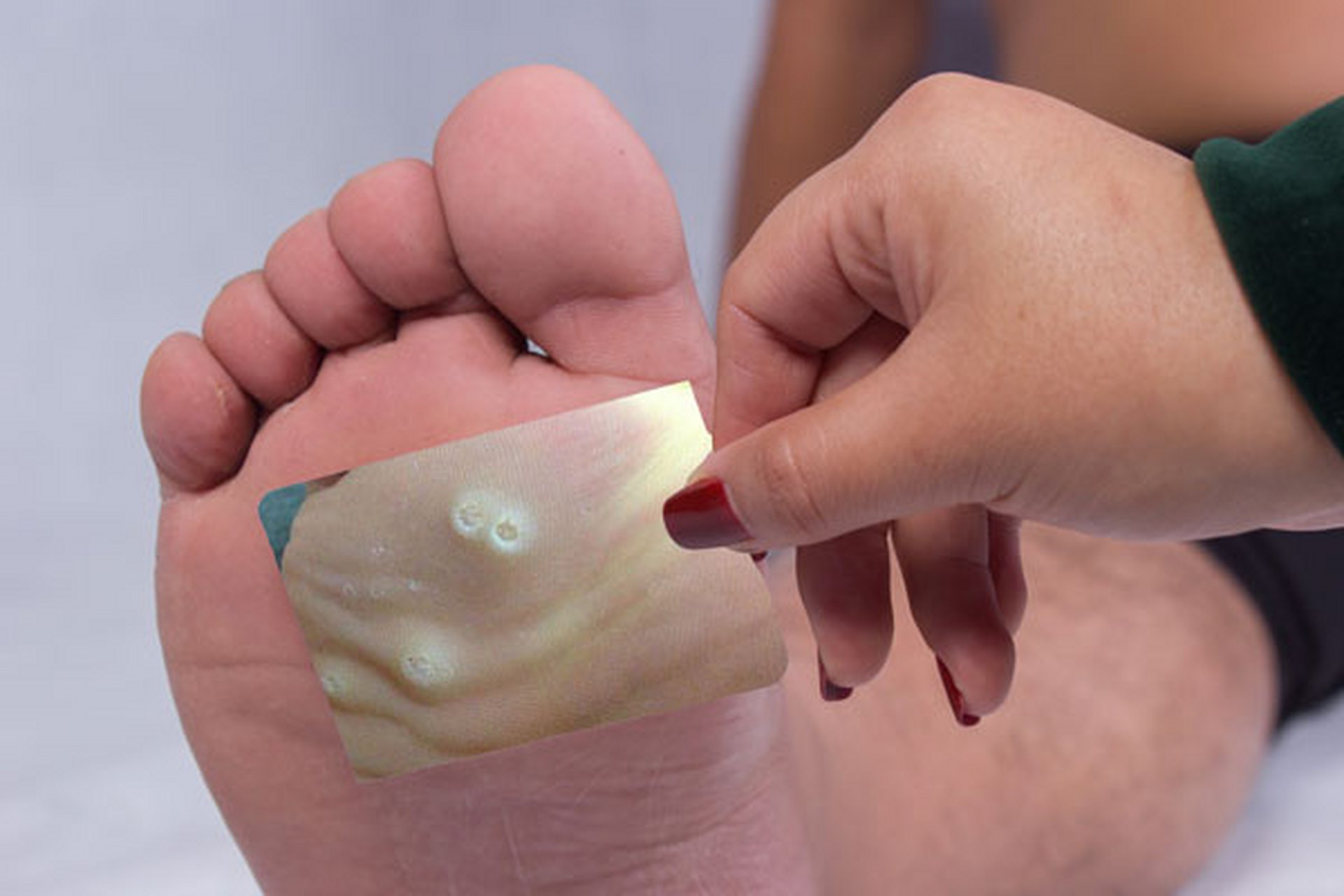 鸡眼# 初期是否会引起疼痛?