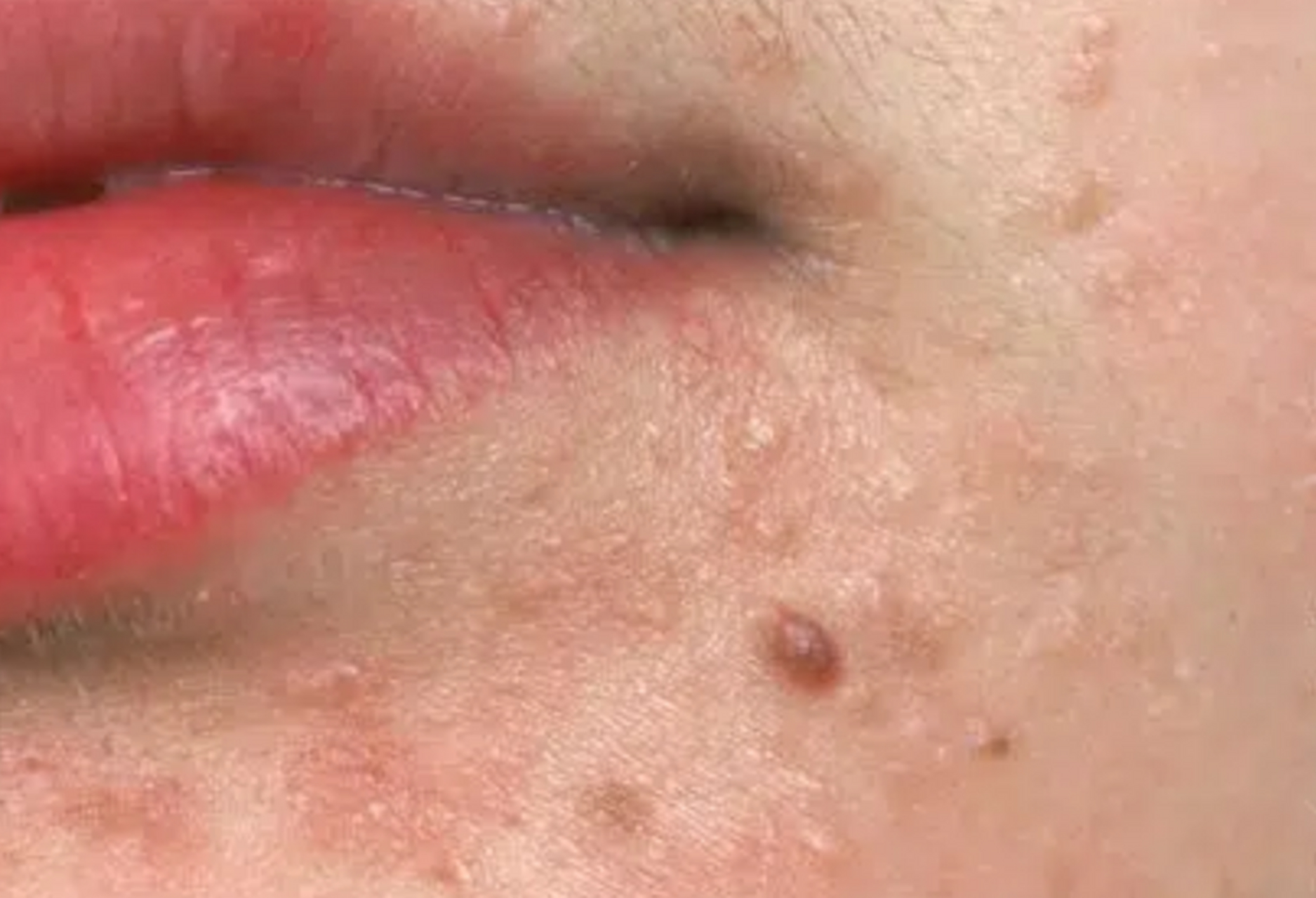 扁平疣是一种由人乳头瘤病毒(hpv)感染引起的皮肤病,它的复发与以下