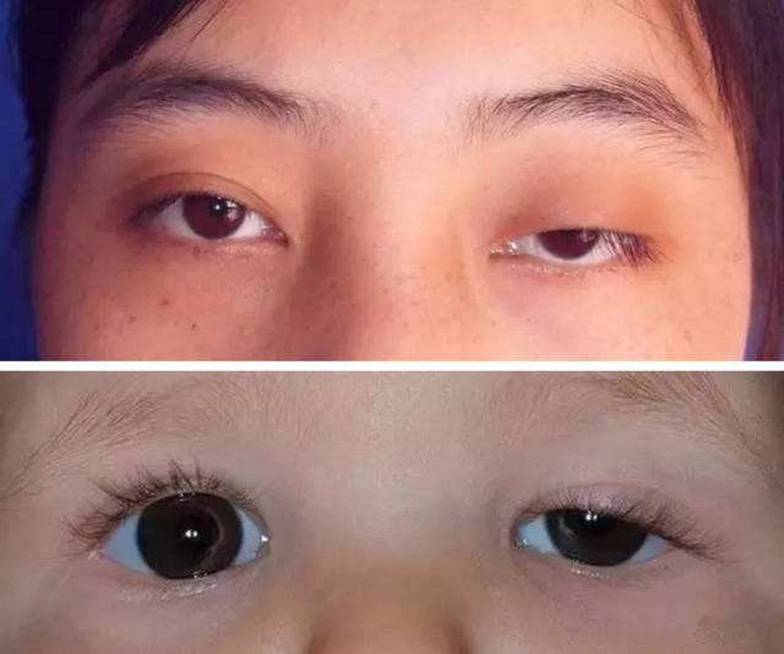 上眼睑肌无力一定要手术吗?