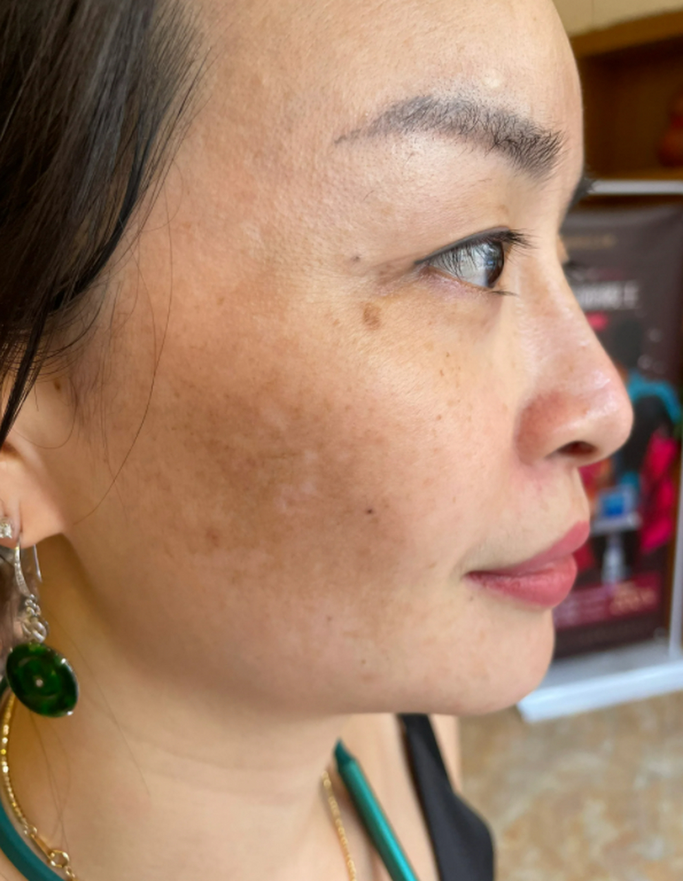 黄褐斑是一种常见的皮肤问题,它们通常出现在面部,颈部和手背等暴露于