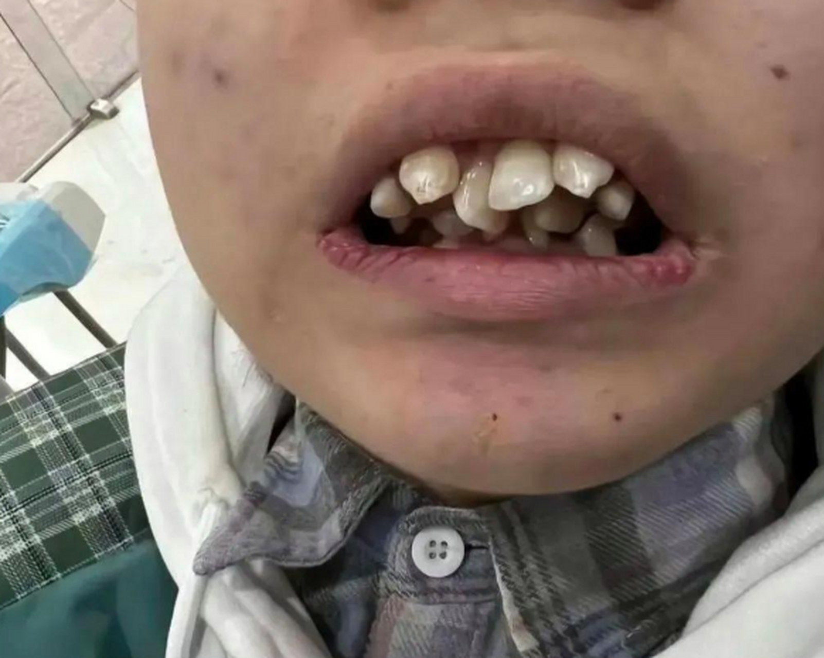 这牙齿还有救吗?牙医都说现在的孩子吃东西太精细了,好多长双重牙的!