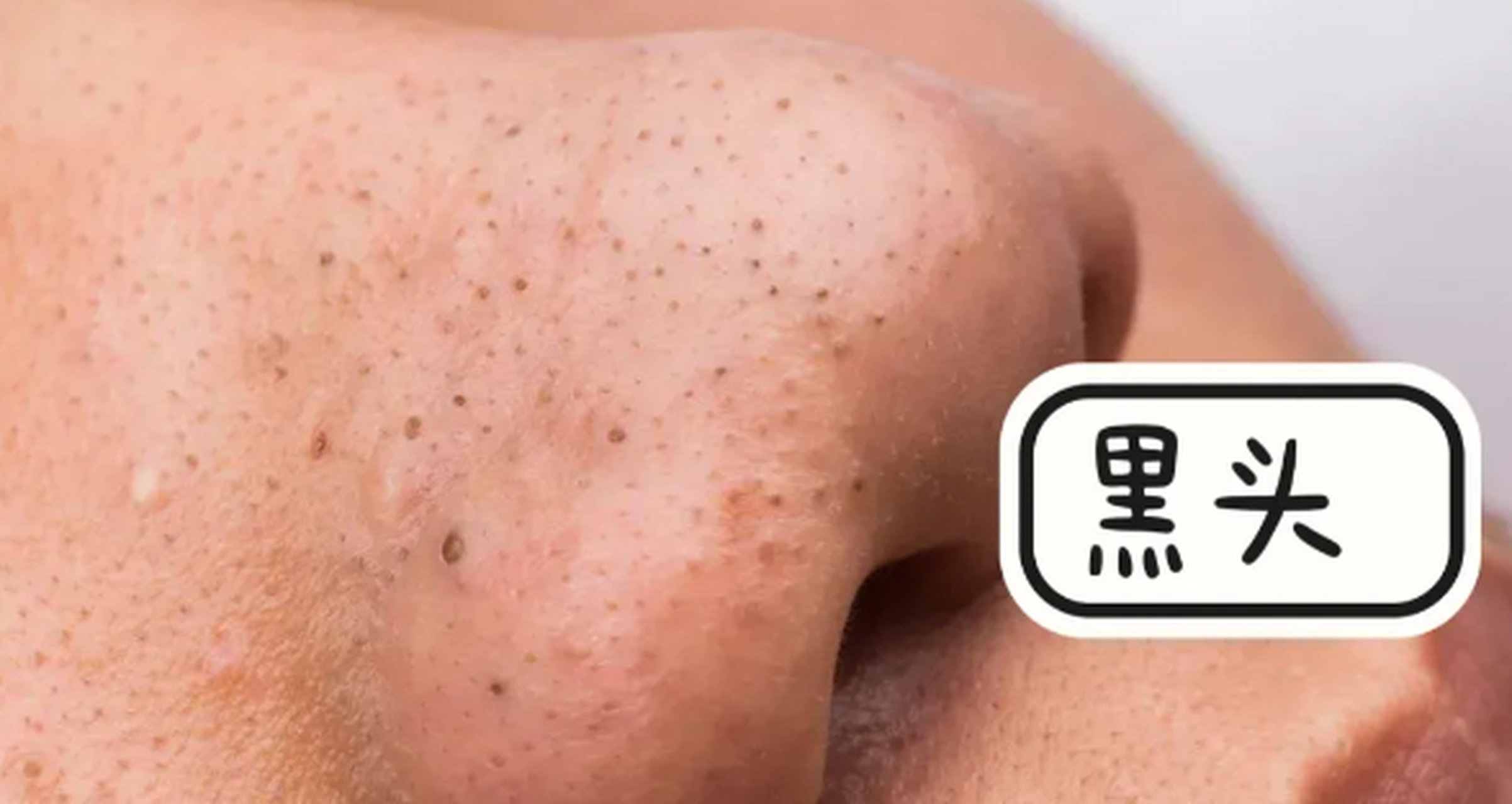 教你5步沉浸式去黑头  1,先热敷(用温毛巾)打开毛孔;  2,再用氨基酸