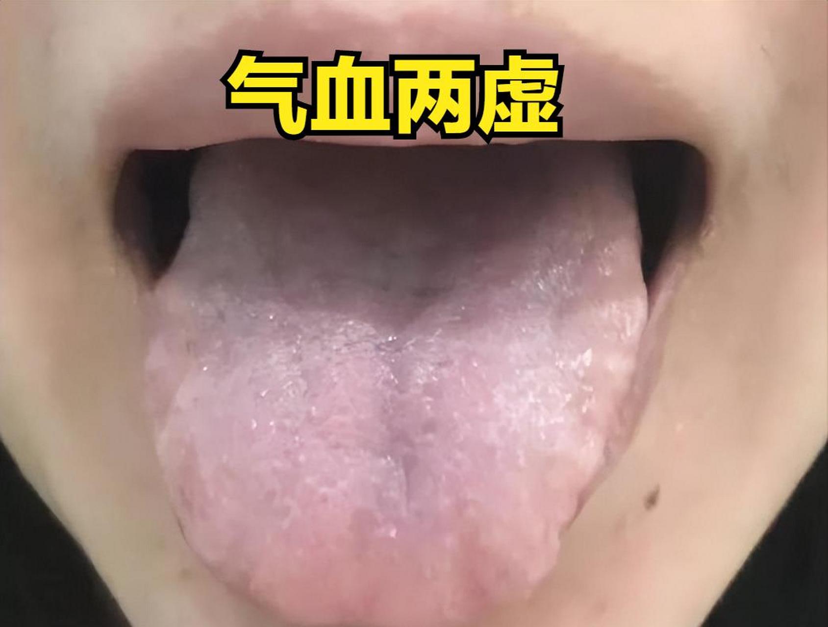 1,脾虛溼盛 表現:舌頭偏胖,撐滿整個嘴巴,舌邊齒痕明顯.