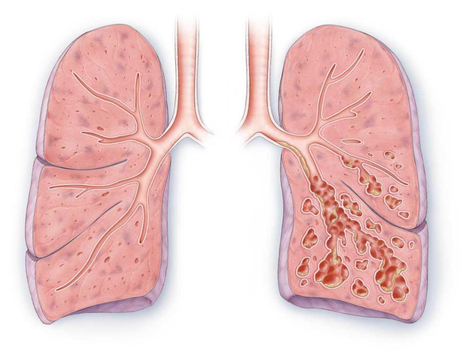 支气管扩张图片样子图片