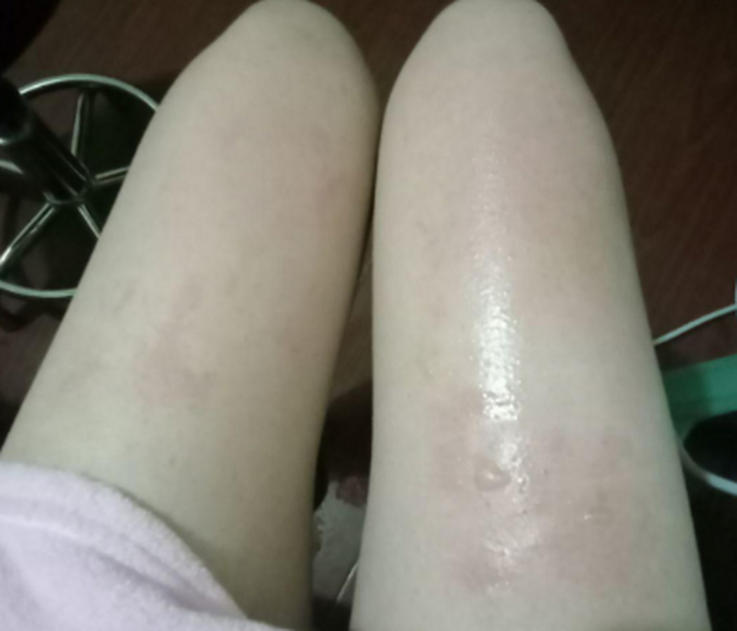 腿烫成这样会不会留疤?