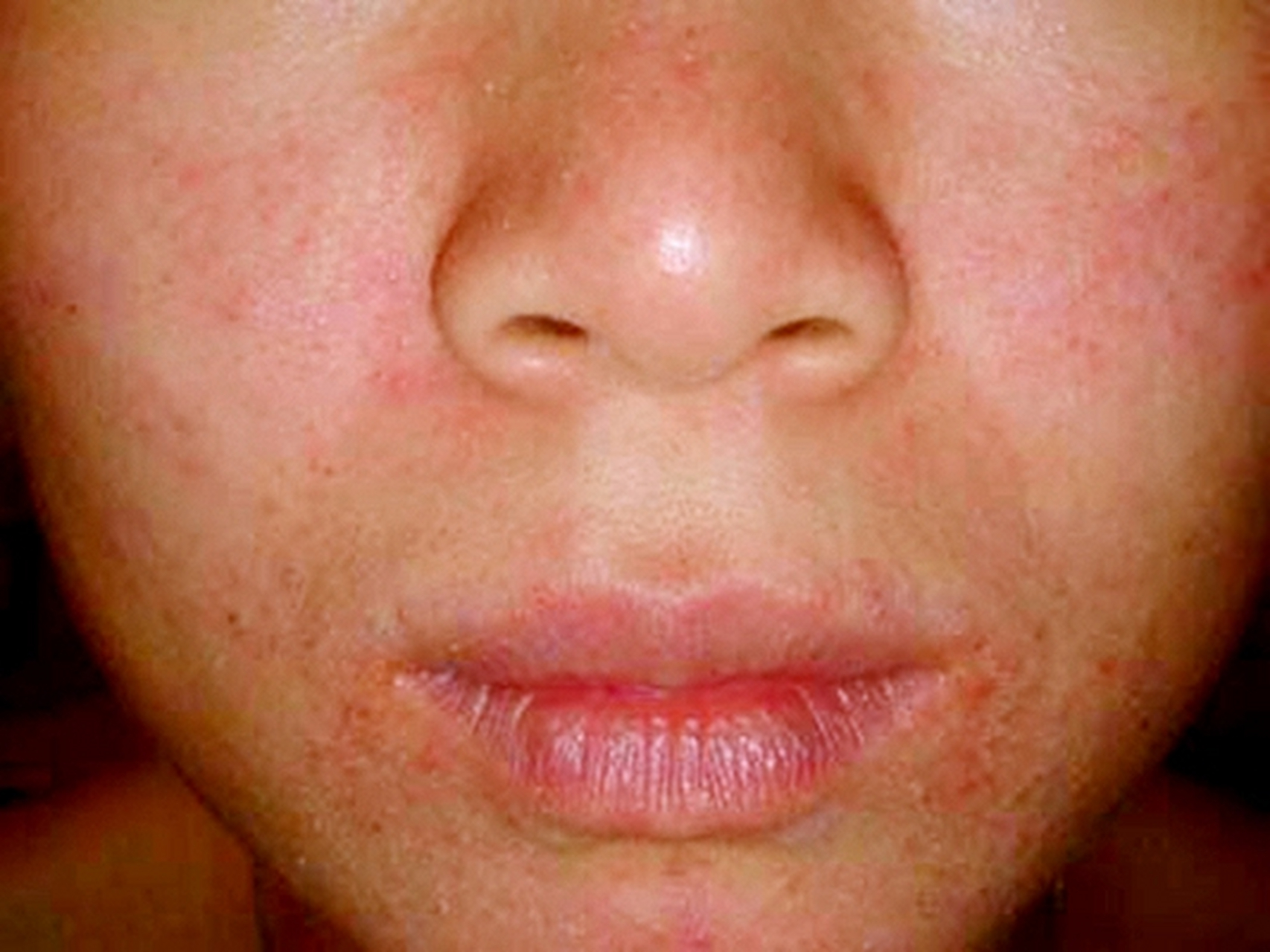 脸上脂溢性皮炎多久会好,需根据脂溢性皮炎的类型决定.