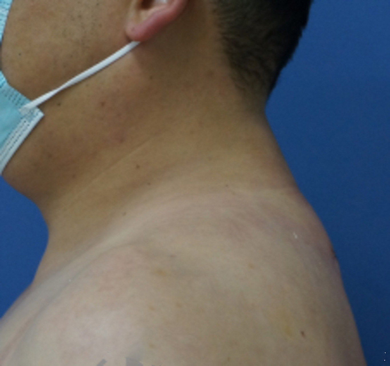 富贵包是一种良性脂肪堆积,通常是由于不健康的