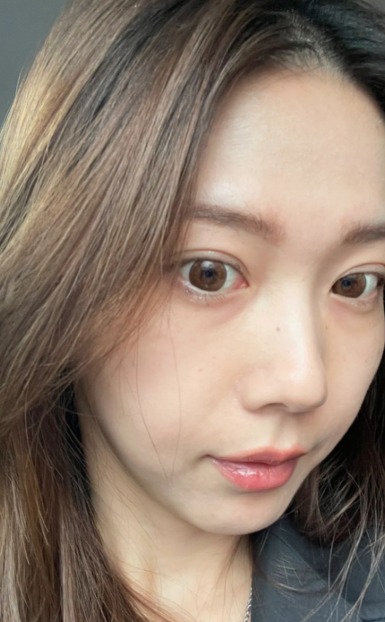 泪痕沟怎么去除 #医美科普挑战赛#  人的泪痕沟是指眼角下方的纹路