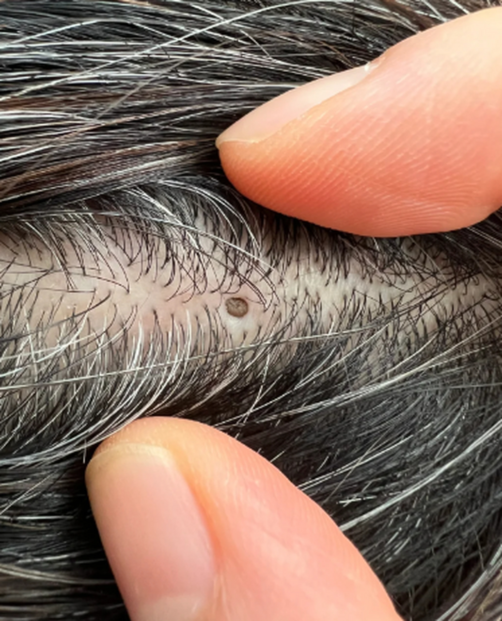 头上有个巨大黑头怎么办