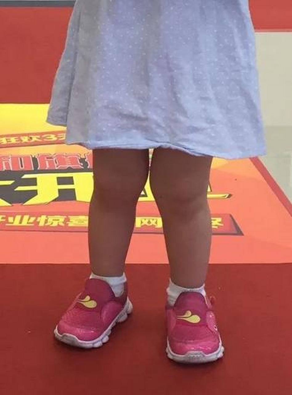 2岁半宝宝儿保时发现x型腿,跑步有点爱摔跤,请问需要处理吗?  不需要.