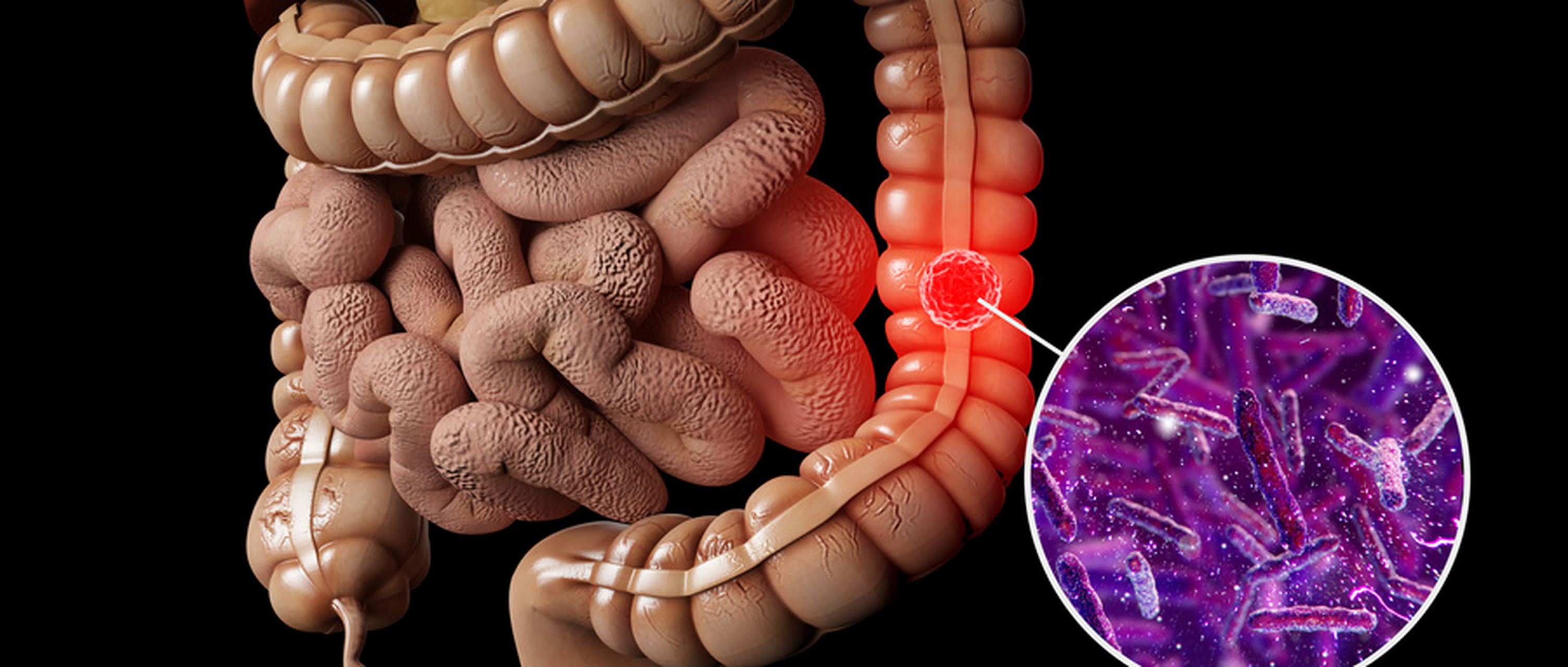 肠道健康#肛肠疾病的十个危害   1,引起痔核脱垂,嵌顿甚至坏死,水肿