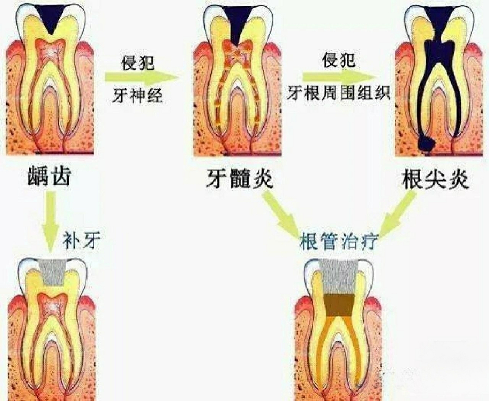 根尖周炎每种情况治疗方法  根尖周组织破坏的大小及个体的修复能力不
