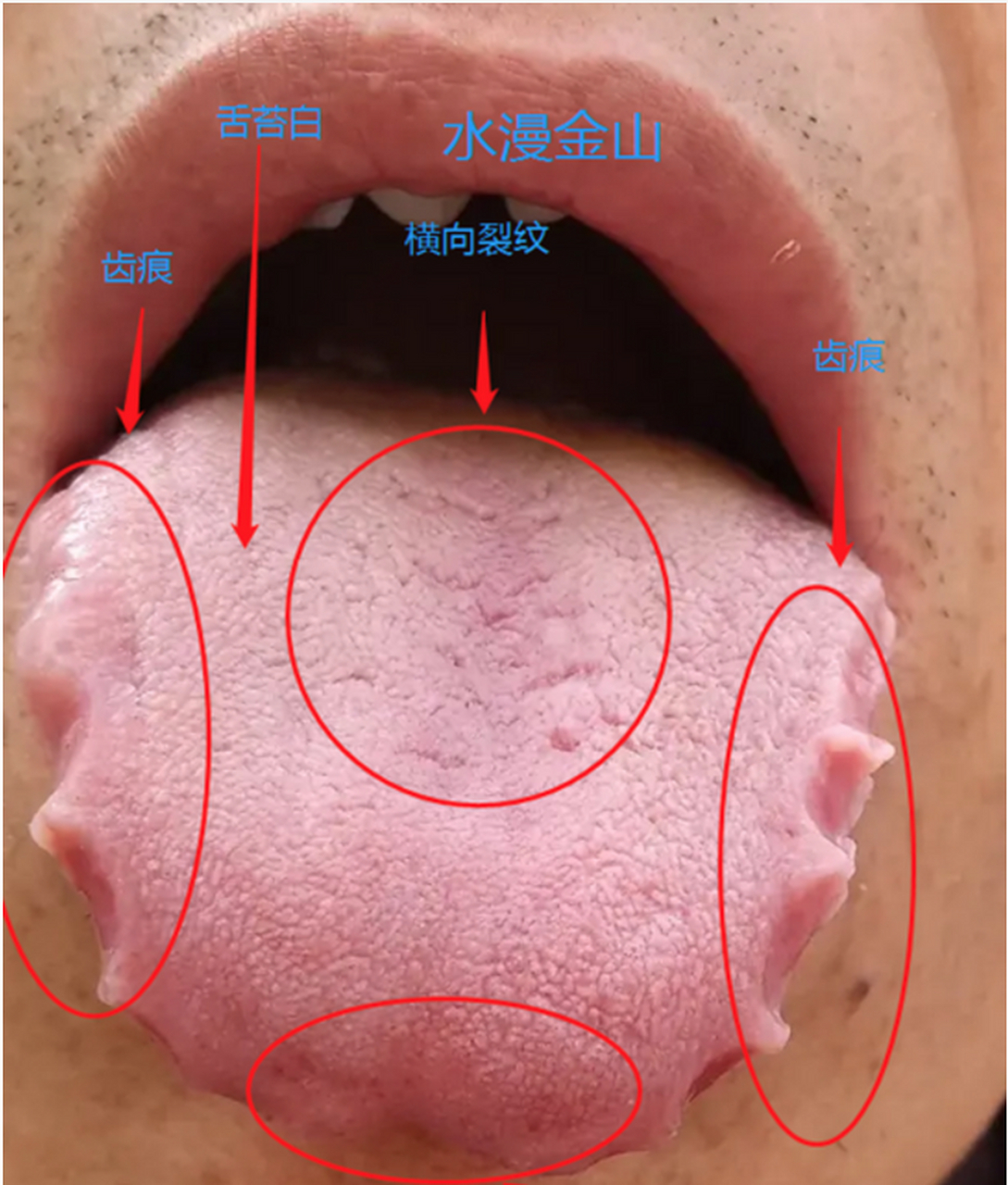 湿气舌苔对照图片图片