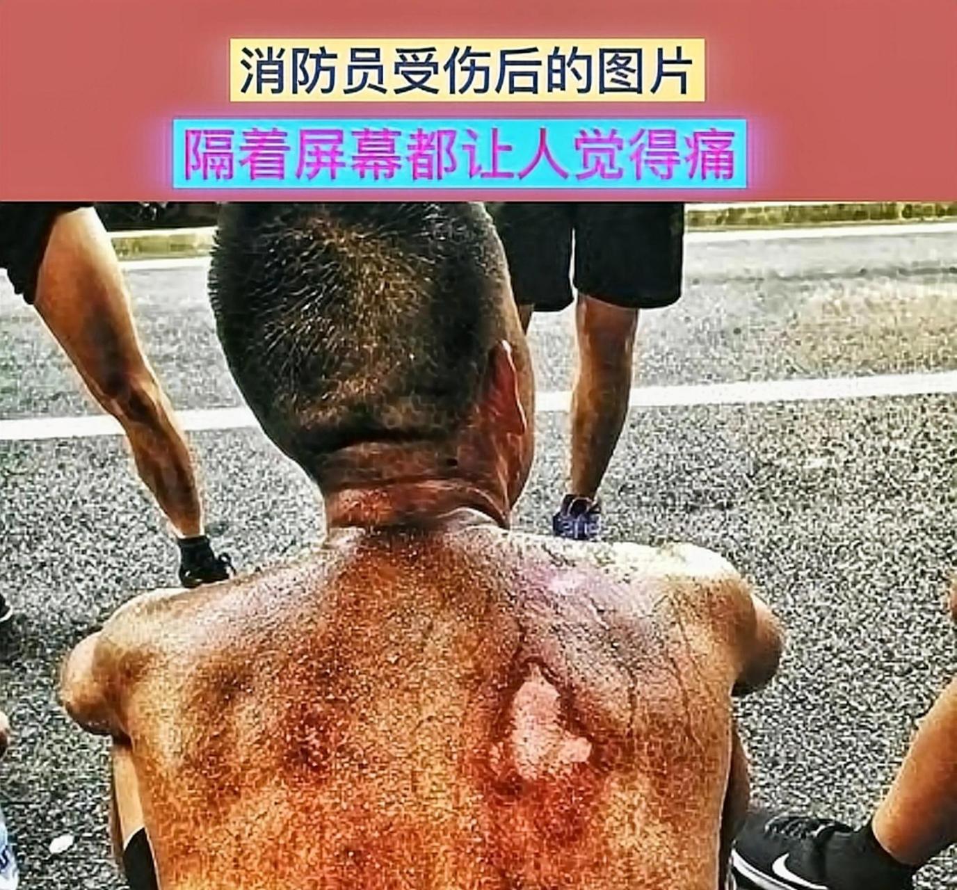 看着这一幅幅消防员受伤的图片,隔着屏幕都觉得疼,不由得让人泪目.