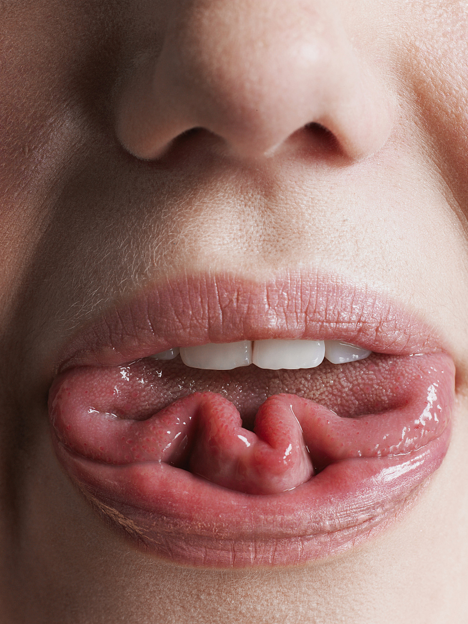 舌癌是一种常见的口腔癌症,通常发生在舌头的表面或深部组织.