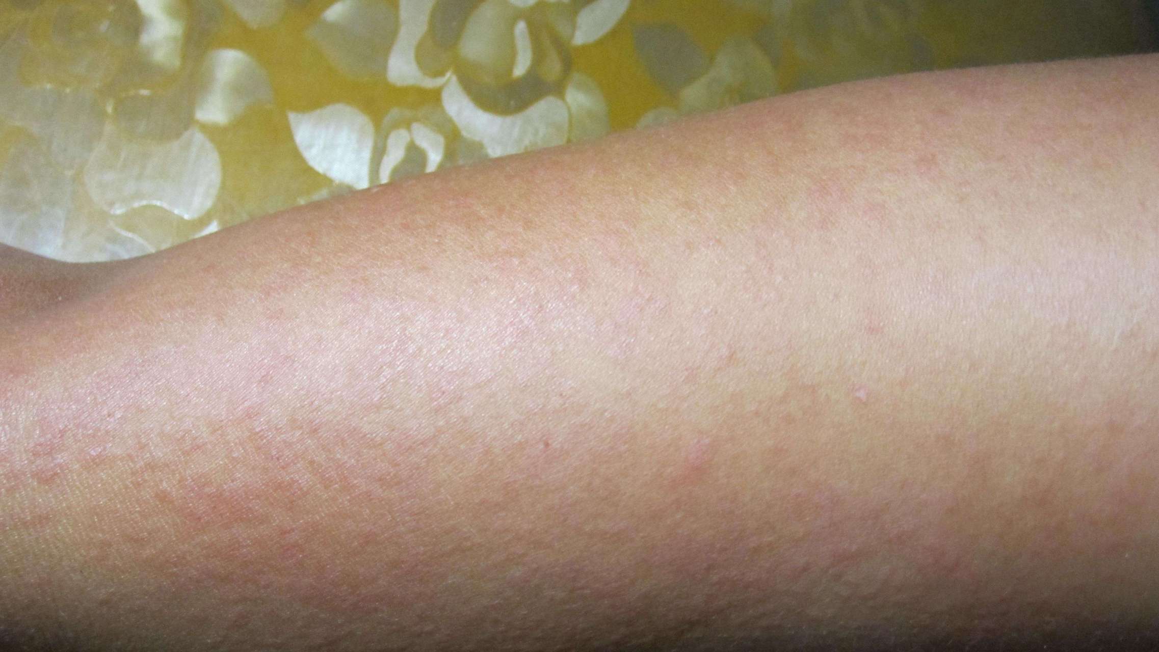 光敏性皮炎# #皮肤病# 光敏性皮炎主要是由于患者皮肤对太阳光产生