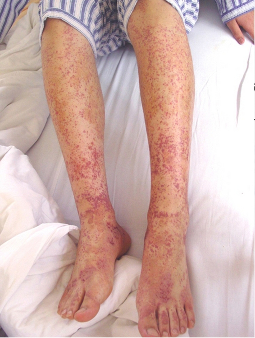 肾病案例 :今天讲的还是紫癜肾病例,这个病人跟昨天的病例患者一样都