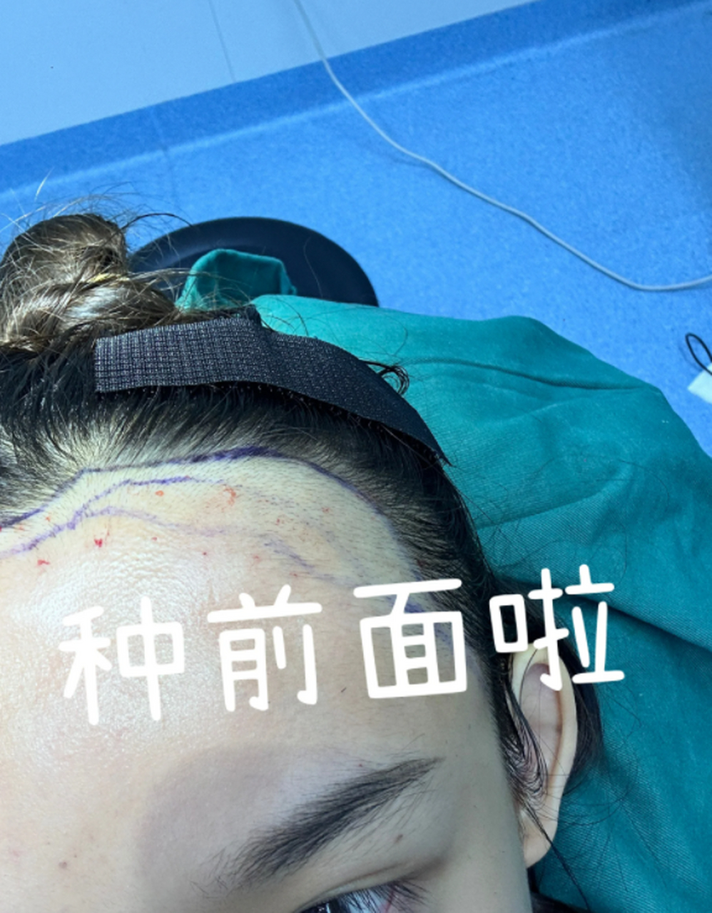 植发美学(植发美容一般多少钱)