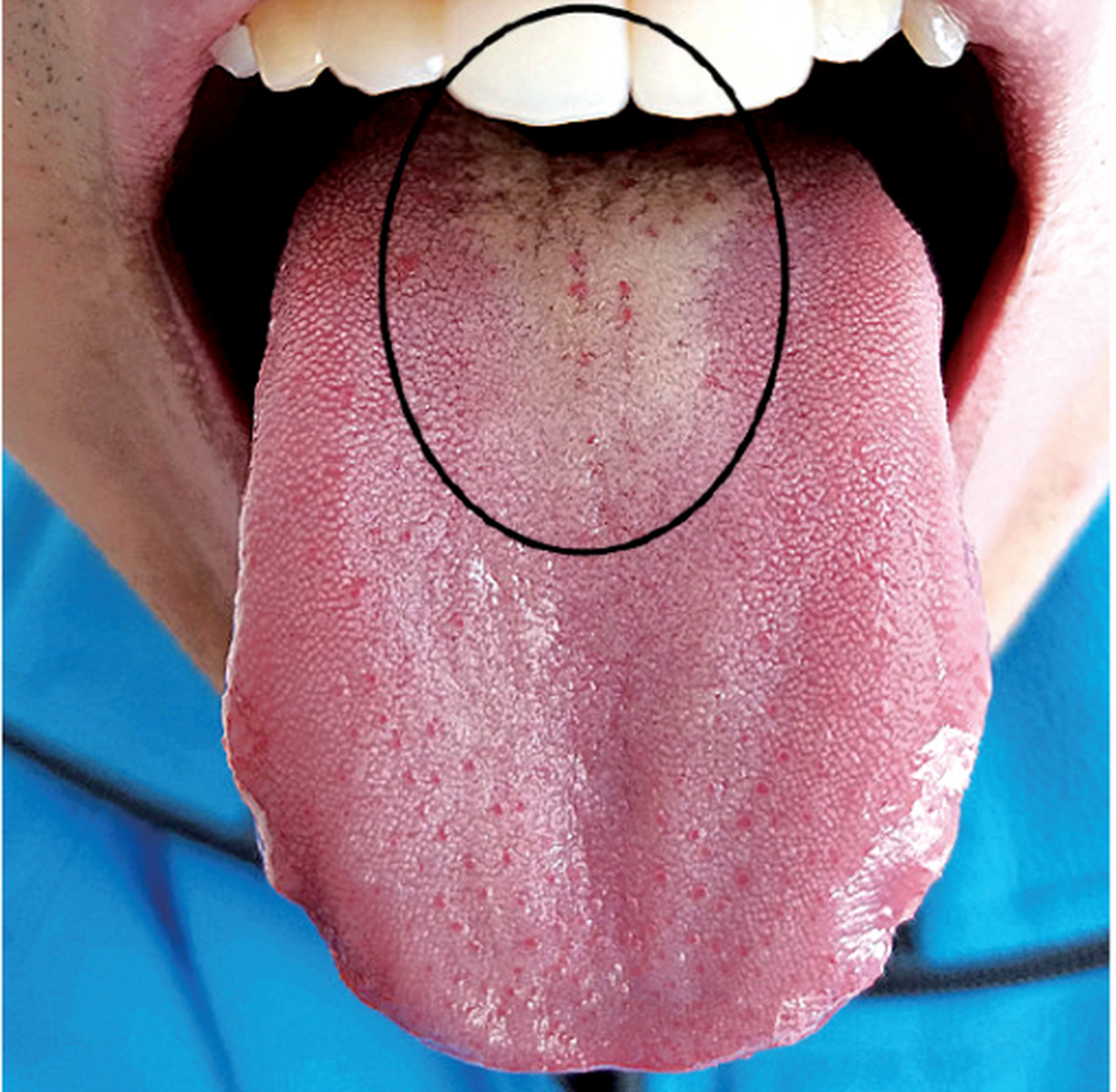 舌苔特别厚的地方是病 中医舌诊里面有一句话叫"独厚者病"是独处藏奸