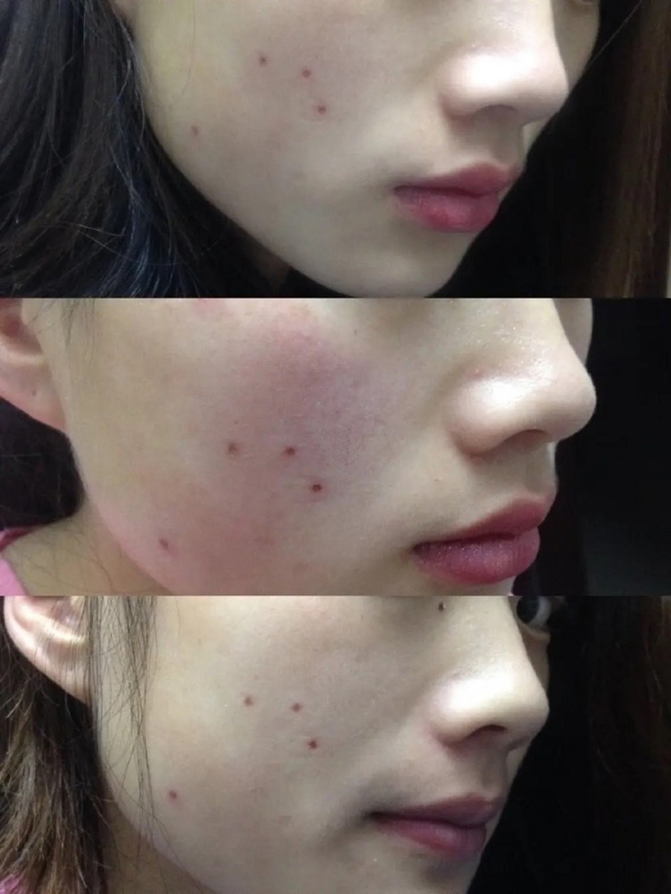 点痣有什么忠告吗?  1,留疤.