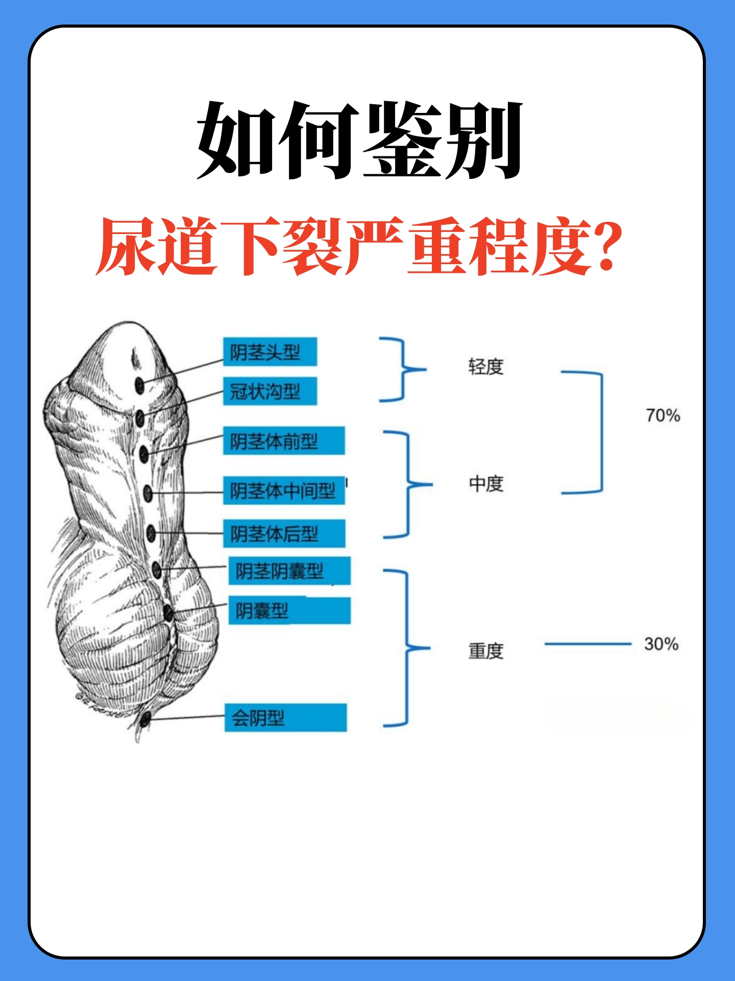 如何鉴别孩子尿道下裂严重程度?