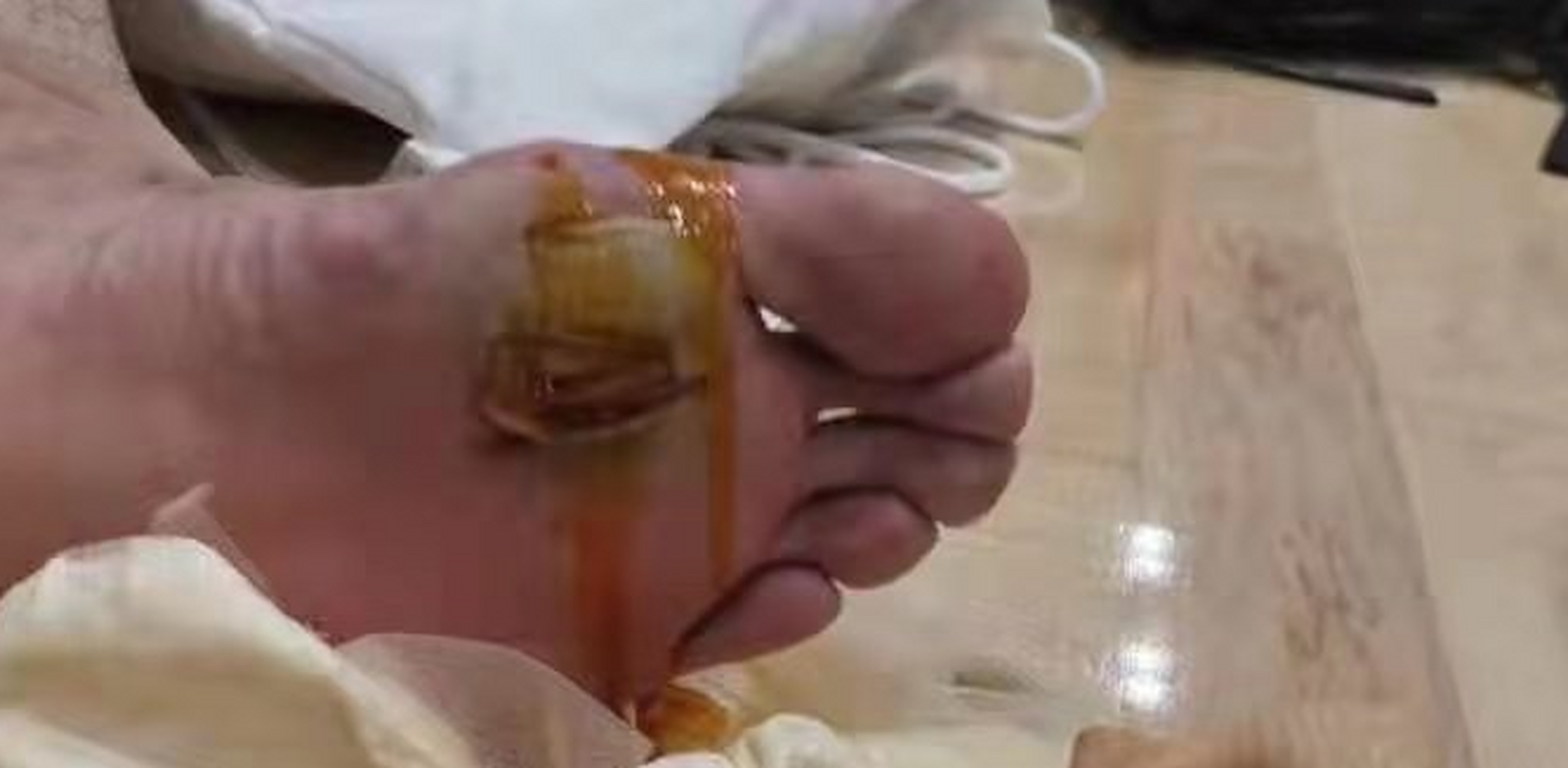 谌龙脚底长了大血泡!