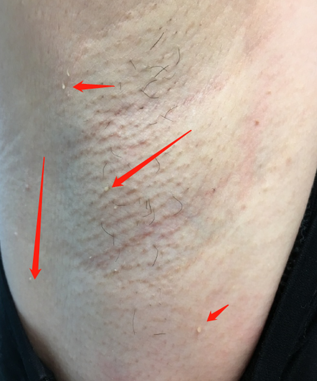 【hpv小知识】腋下多发性的丝状疣,也是一种hpv病毒感染.