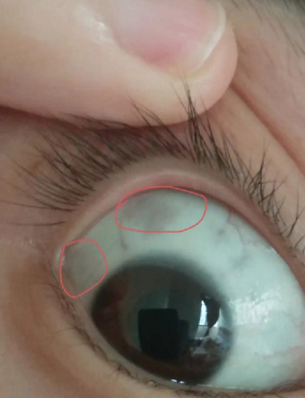 有没有懂的,眼睛里灰色的斑是啥情况呀?