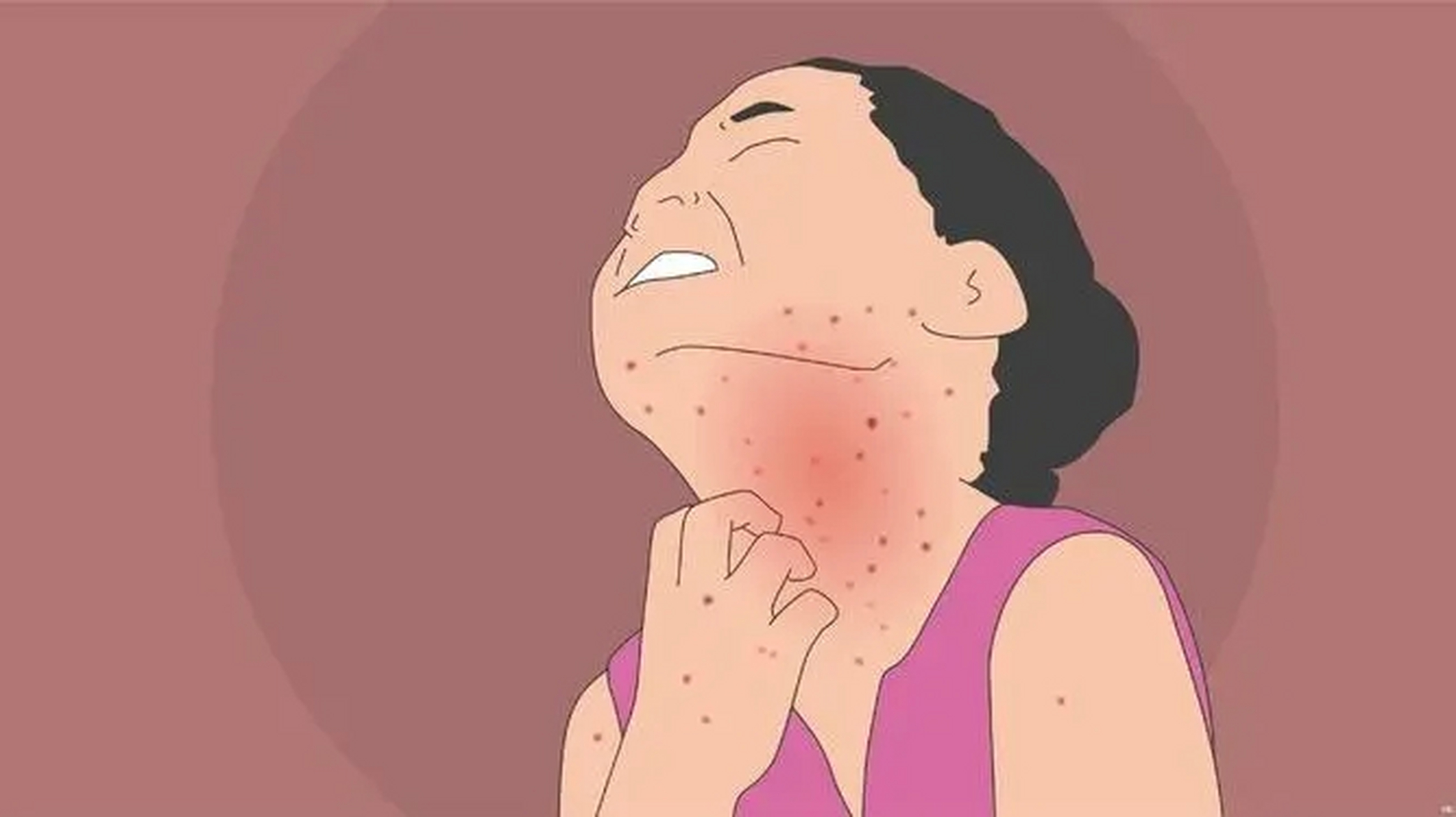 神经性皮炎它是一种局限性的皮肤神经功能障碍性皮肤病,常常以瘙痒和