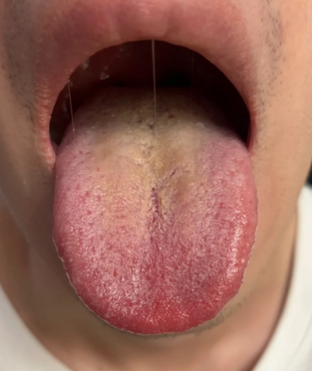 说到湿气下注的症状.
