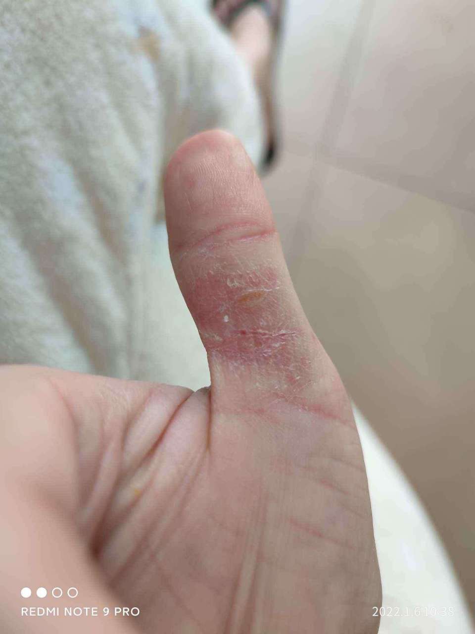 【患者提问】女,22岁,手上爆皮,还裂口了,这是怎么来的呢?