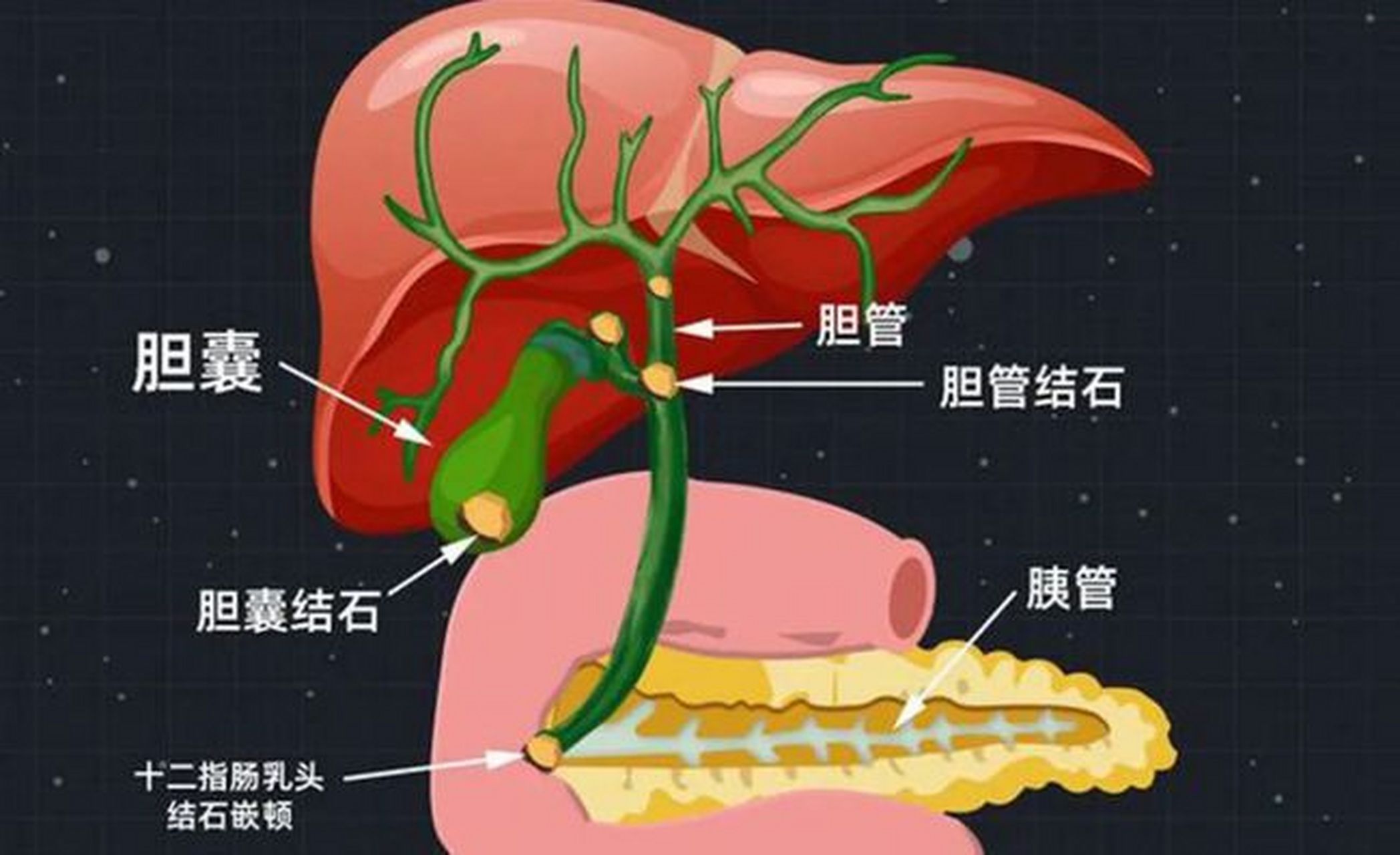 一些胆结石不过是肝胃不和罢了 在今天的讨论中,我们将聚焦于胆结石病
