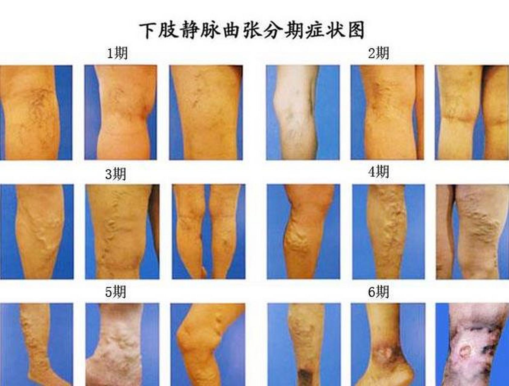 临床上,静脉曲张按照发病时间长短及轻重程度分为6级,看完你就可以做