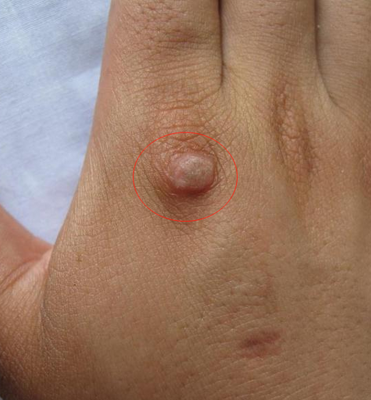 男性这3处长疙瘩,提醒你感染hpv,千万别是第3种  如果感染了不同的hpv