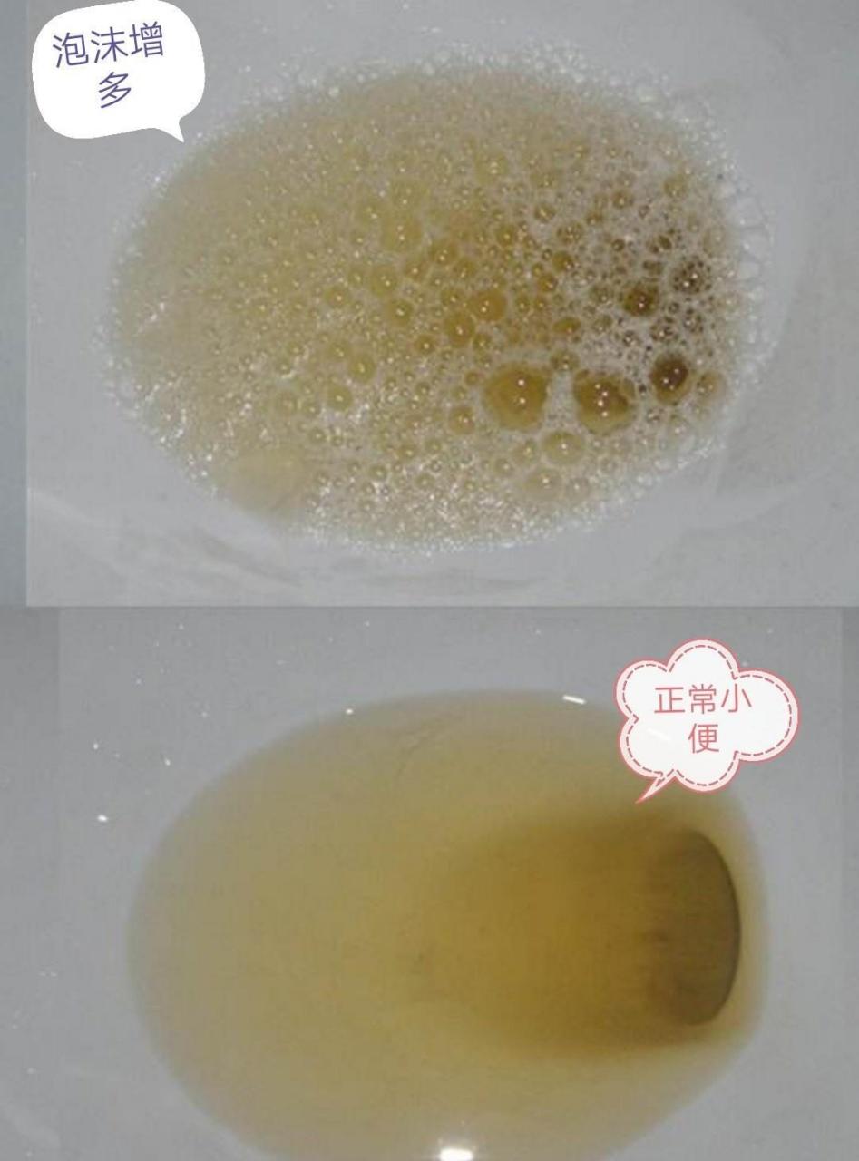 如果不及时治疗,蛋白尿的后果将不可预测