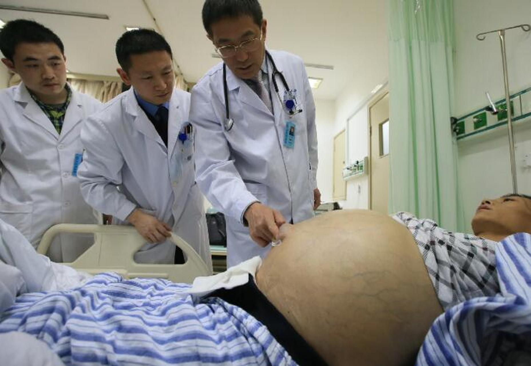 肝癌晚期,为什么肚子胀大如鼓?