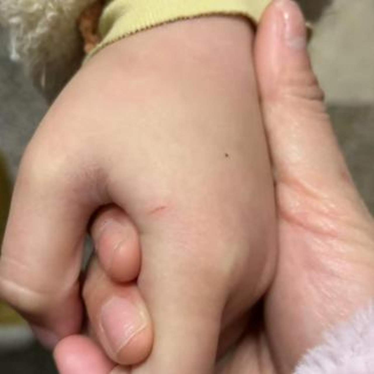 闺女的手,被一个月的小狗,咬伤了!就这一点伤口,需要打狂犬疫苗吗?