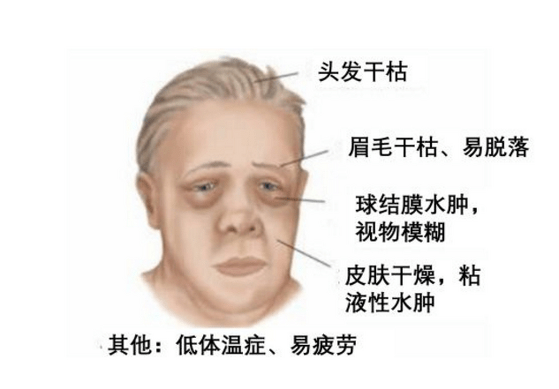 甲减变胖,变丑,2个方法帮你"挽回颜值" 都说甲减会变丑,这在中医上呢