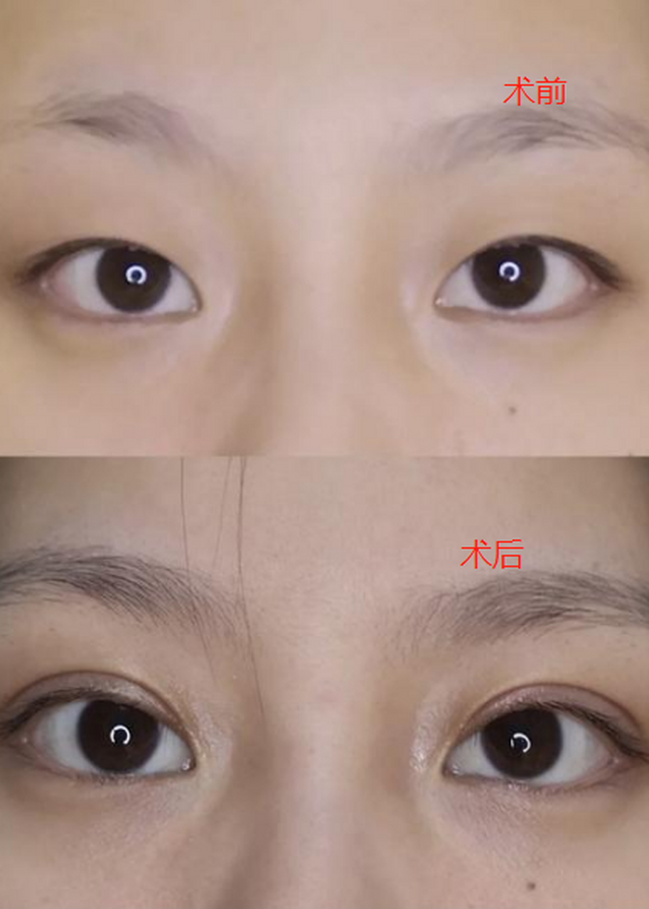 肿眼泡可以只抽脂不割双眼皮吗?