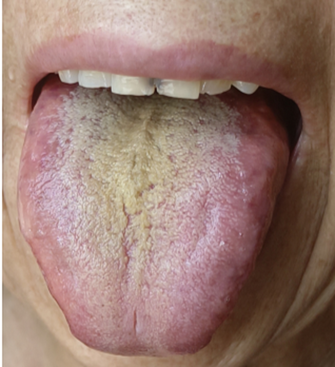 舌头中间有一条沟图片