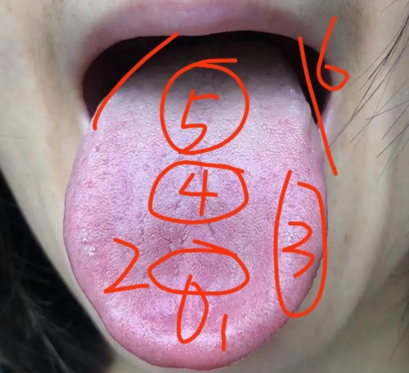 阴虚和血瘀舌像的区别 这个舌像在舌前看似舌淡红苔薄,是阴虚的舌像.