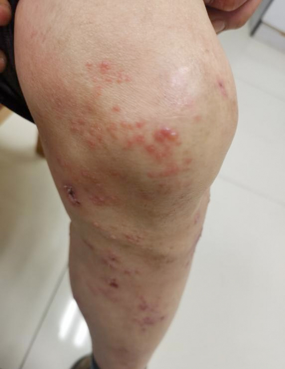 一位患者周末去钓鱼,回来第二天发现腿上长了很多泡泡,而且痒的厉害.