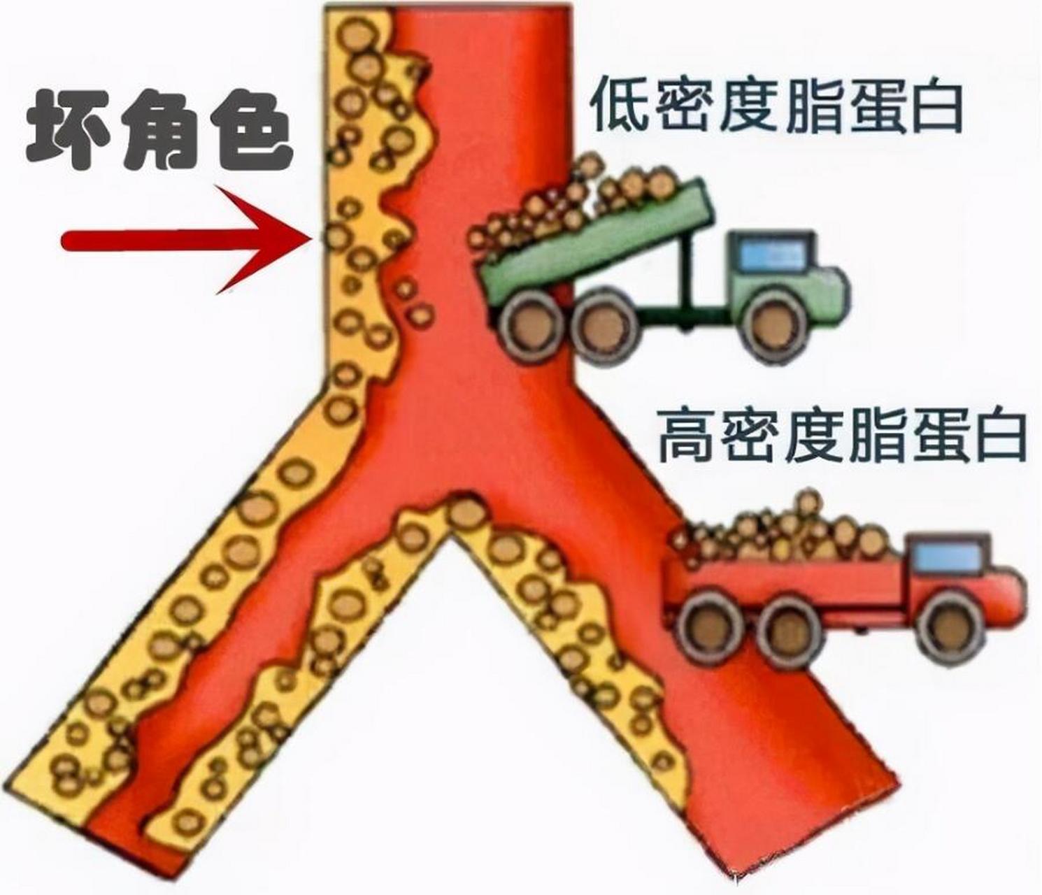 低密度脂蛋白,降到多少才不脑梗 1.正常人群,控制在3.