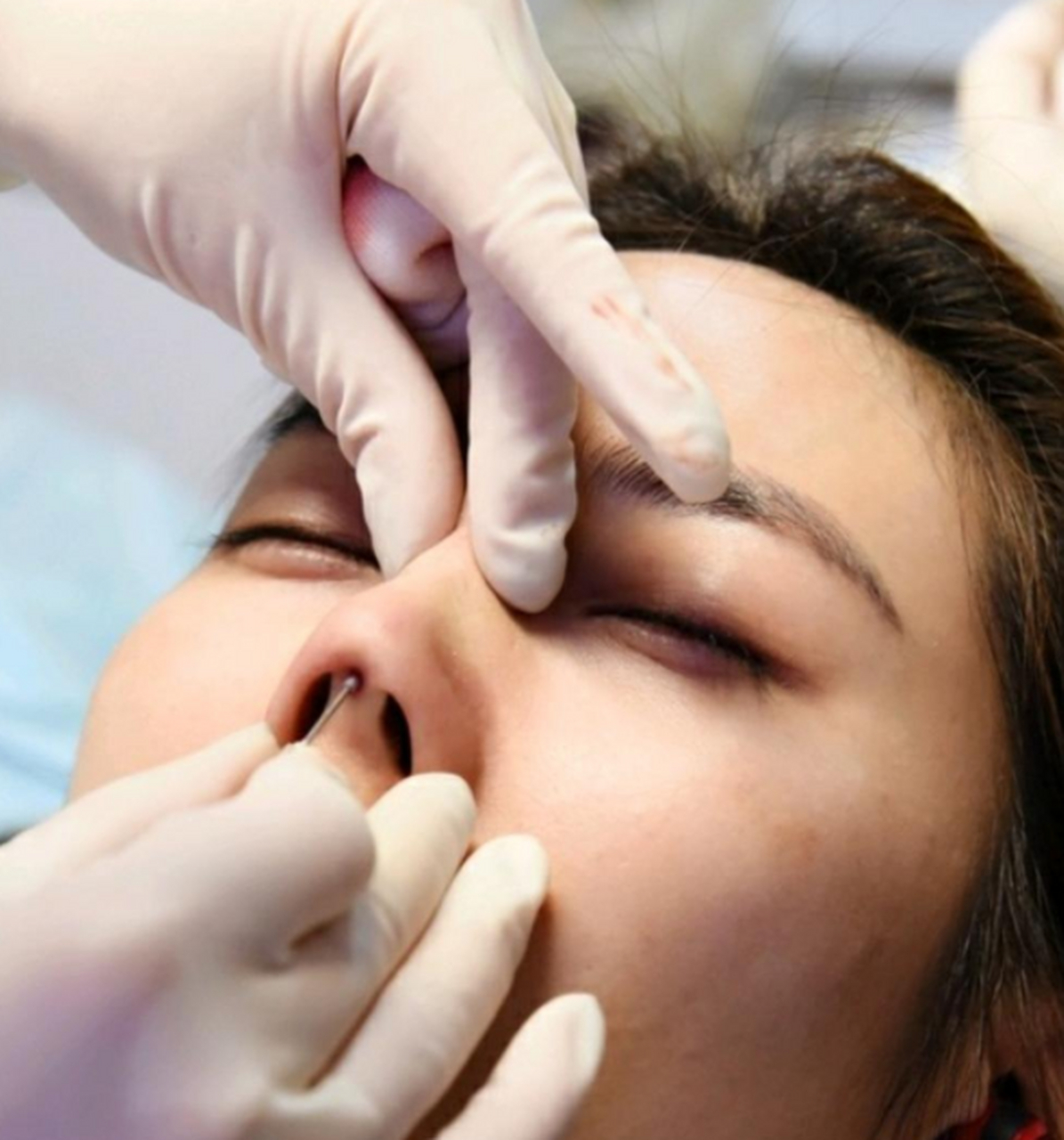 在这里我建议大家不要轻易去尝试#线雕隆鼻#  为什么这样说呢?