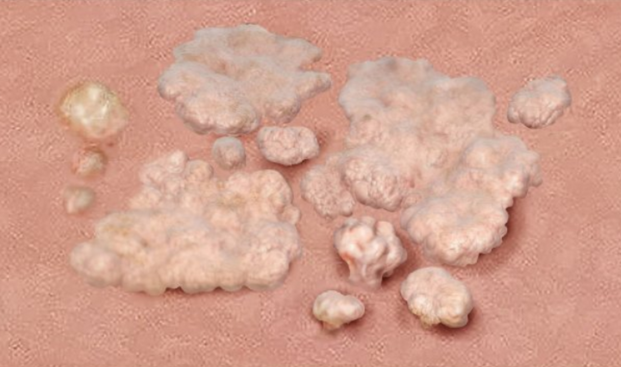 起初,病情可能并无明显的不适感觉,但随着病情的发展,尖锐湿疣可能