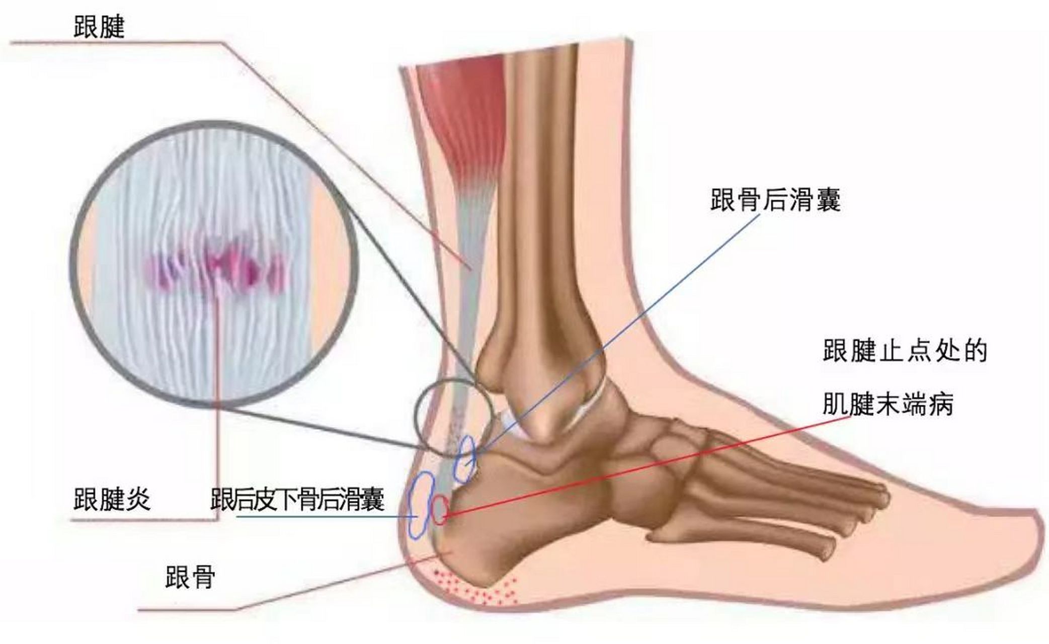 跟腱周围炎位置图片图片